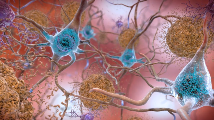 Ilustração mostra placas de proteína beta-amiloide (em laranja) entre neurônios de paciente com Alzheimer (Foto: NIAID-NIH)