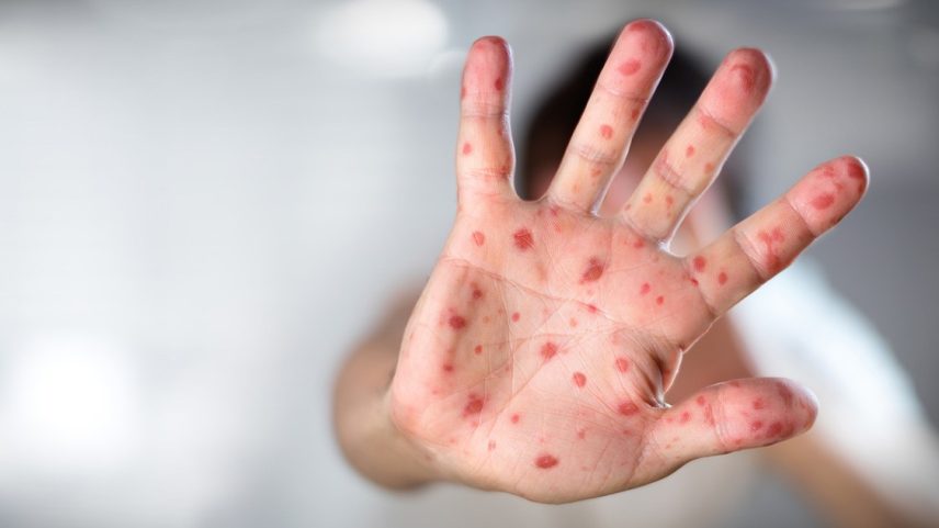 Sarampo é uma das infecções mais contagiosas que afetam os seres humanos (Foto: iStock/iStock)