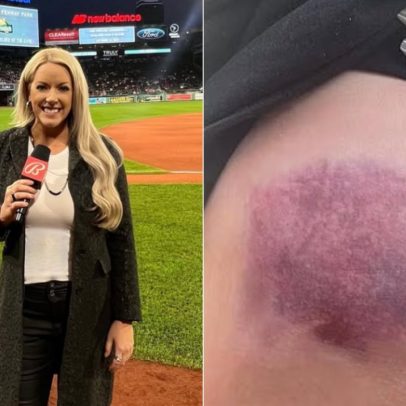 Bola de beisebol atinge repórter e causa hematoma durante partida emocionante