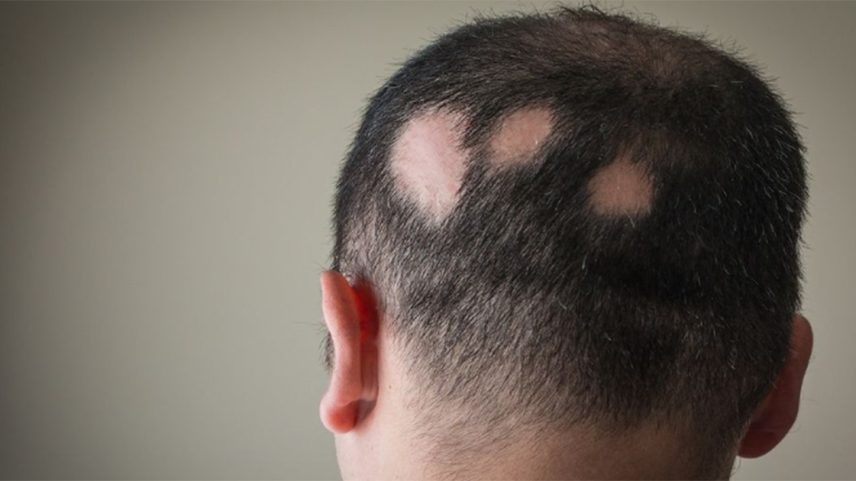 Homem de costas com alopecia areata; o cabelo tem falhas em formatos circulares (Foto: USP Imagens)