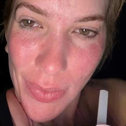 Após irritação, laser de Virginia Fonseca mostra glow up; veja evolução