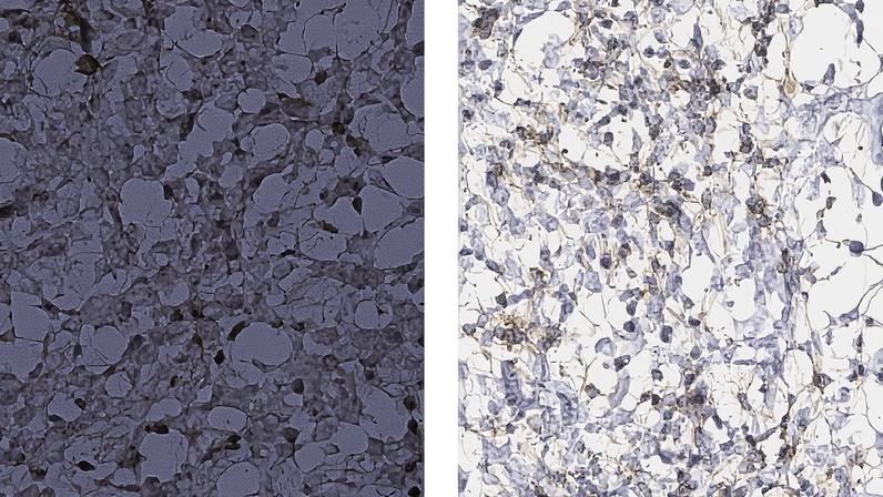 White Lab researchers and their colleagues identified peptide targets by profiling antigens in co-cultures of glioblastoma cells and macrophages, and then developed immunostimulatory treatments to test the targets’ validity. Treated mouse models of glioblastoma tumors (right) show a significantly larger infiltration of anti-tumor T cells (brown) than their untreated counterparts.