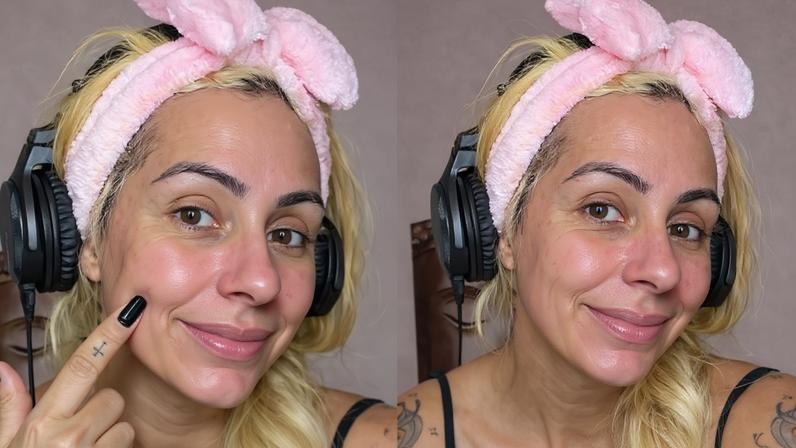 Miss Bumbum expõe reação alérgica após usar sangue da menstruação como skin care; médica aponta riscos de infecção e agravamento de acne