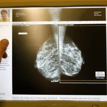 IA em triagem de câncer de mama reduz diagnósticos tardios em 12%