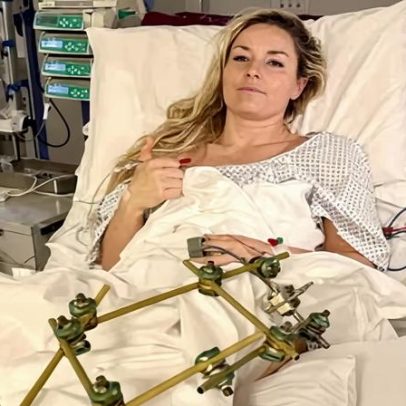 Lindsey Vonn fará quarta cirurgia após fratura na perna