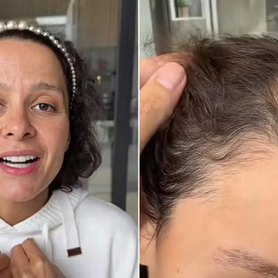 Maiara revela alopecia androgenética e celebra avanço no tratamento