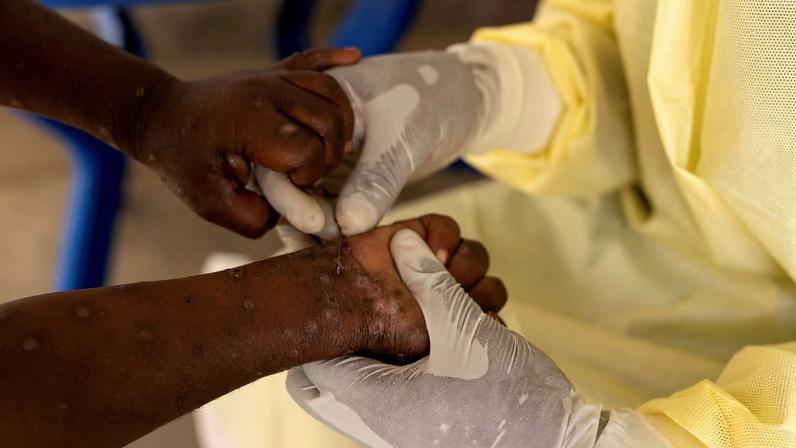 Brasil registra 88 casos de Mpox em 2026; saiba como se prevenir