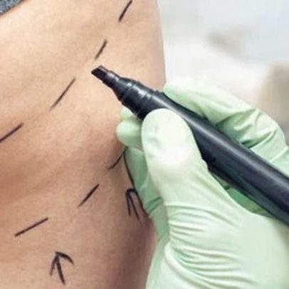 MPs pedem banimento do lifting de glúteos brasileiro no Reino Unido por indústria desregulada