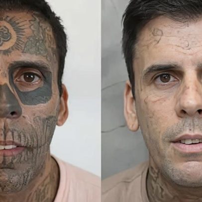 Mais tatuado do Brasil faz nova remoção e fala em vida missionária