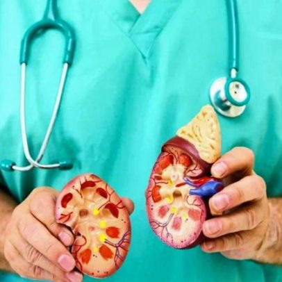 Desigualdade no cuidado afeta vidas de pacientes com câncer de rim