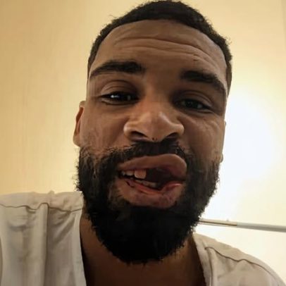 Atacante inglês posta foto sem dentes após fratura de mandíbula no Milan