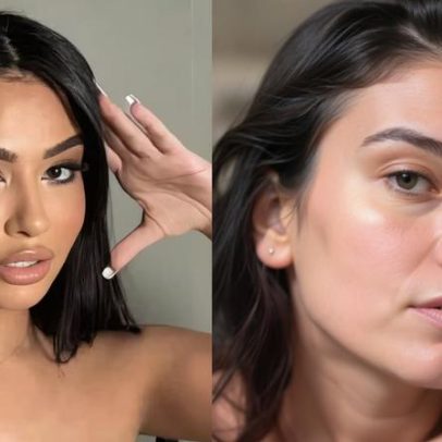 Influencer faz cirurgia estética e revela motivo: achou que reduziria a idade