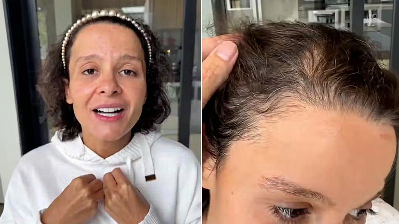 Maiara, dupla de Maraisa, relata trauma com a queda de cabelo: 'Não conseguia olhar no espelho'