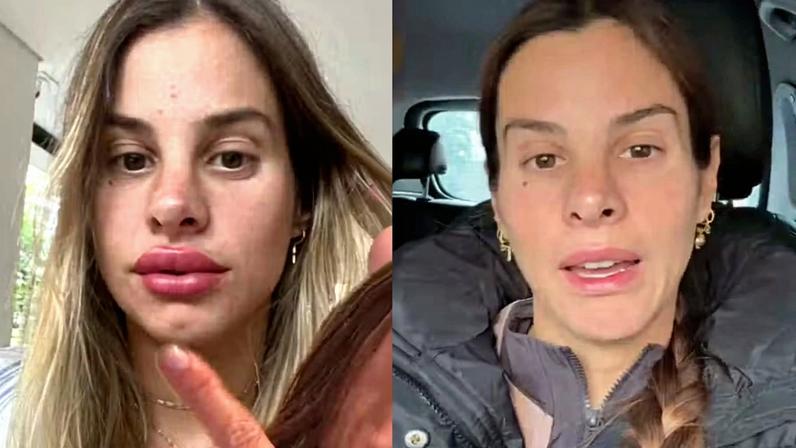 Shantal Verdelho relembra reação inesperada após procedimento estético: 'Deu medo' — Foto: Reprodução/Instagram