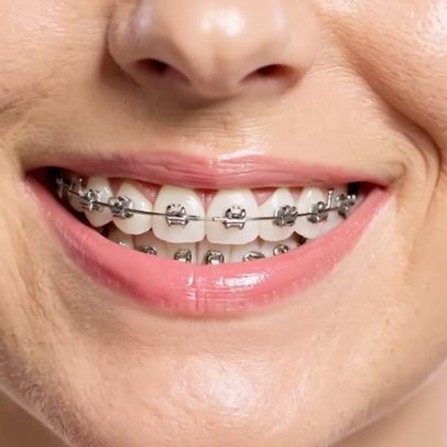 Razões para os dentes voltarem a entortar após o tratamento com aparelho