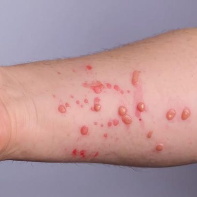 Nova cepa recombinante da Mpox preocupa a OMS; antiviral mais usado não funciona