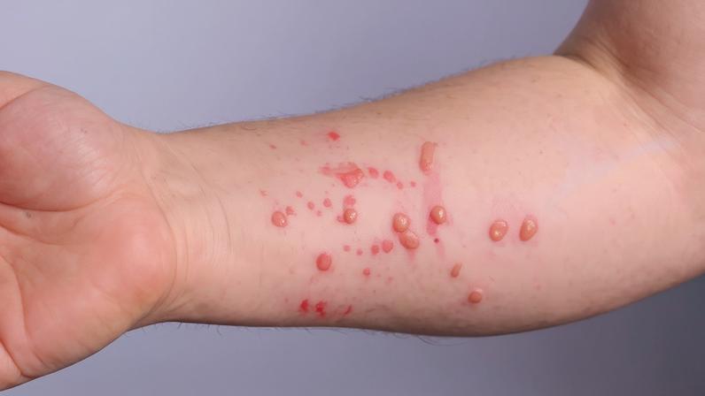 Fotografia da feridas causadas pelo mpox.