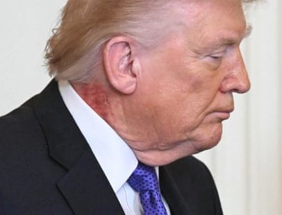 Erupção no pescoço de Trump após tratamento de pele preventivo, diz Casa Branca