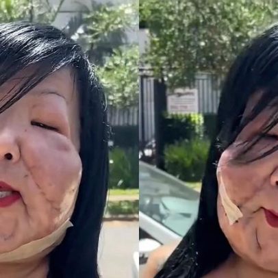 Juju do Pix mostra resultado de nova cirurgia; detalhe no rosto chama atenção