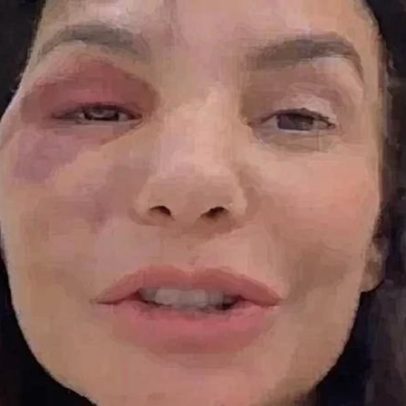 Ivete Sangalo tem olho roxo em BBB26, cantora participa de festa