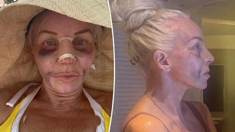 Margaret Josephs broke down her nose job journey via Instagram Wednesday.