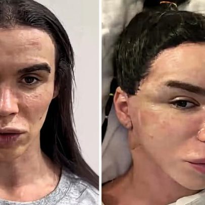 Rafa Uccman faz cirurgia plástica para rejuvenescer pele sem alterar rosto