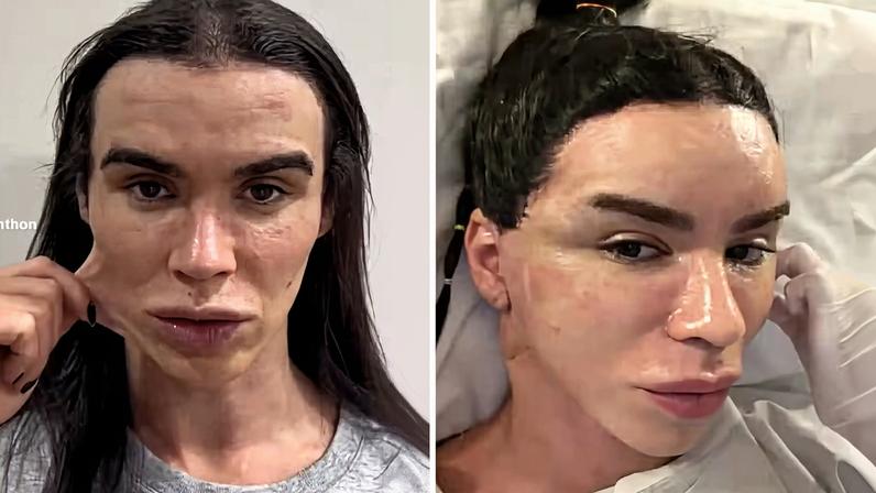 Rafa Uccman faz cirurgia plástica para rejuvenescer pele sem alterar rosto