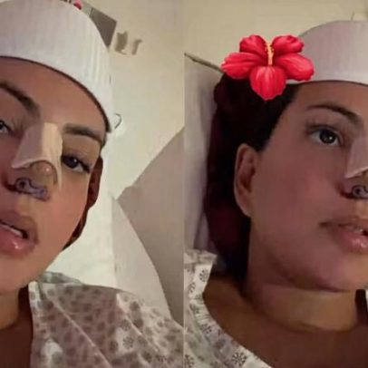 Fernanda Bande realiza retoque nasal