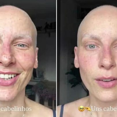 Cabelo de Dani Gondim volta a crescer após fim da quimioterapia