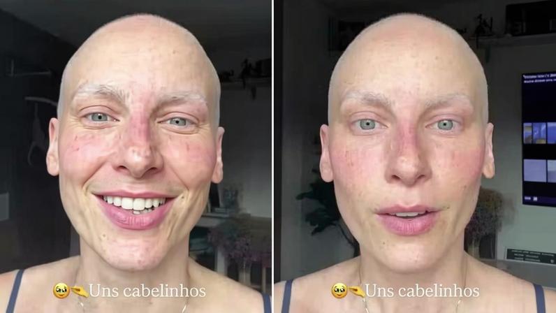 Após fim da quimioterapia, Dani Gondim comemora volta do crescimento dos cabelo