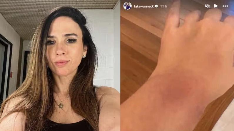 Tata Werneck surge com as mãos machucadas após exames de sangue — Foto: Reprodução/Instagram