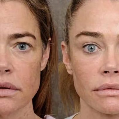Denise Richards mostra antes e depois de cirurgia no rosto