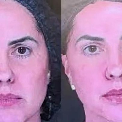 Graciele Lacerda se surpreende com antes e depois de procedimentos estéticos
