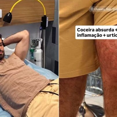 Ator é hospitalizado após ataque de ácaros de palha durante viagem à Indonésia