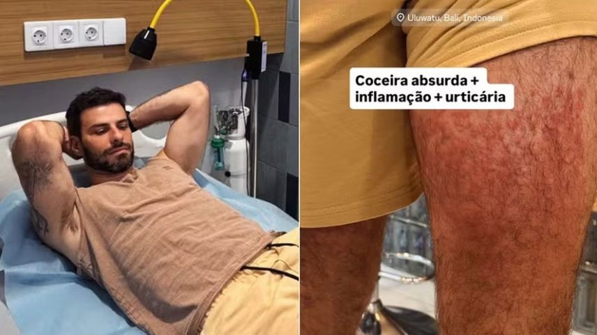 Ator é hospitalizado após ataque de ácaros de palha durante viagem à Indonésia