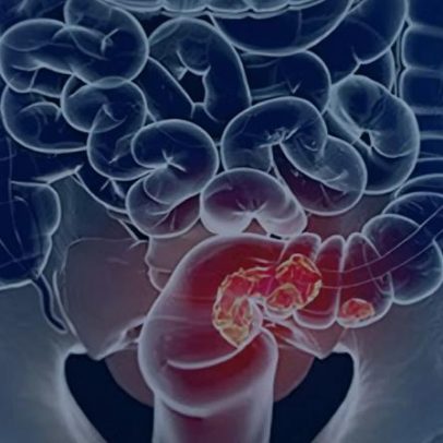 Rastreamento do câncer colorretal pode ser implementado pelo SUS