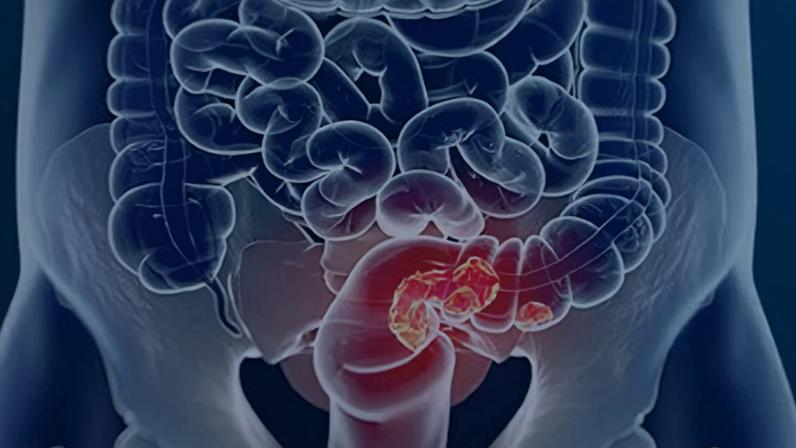 Rastreamento do câncer colorretal pode ser implementado pelo SUS