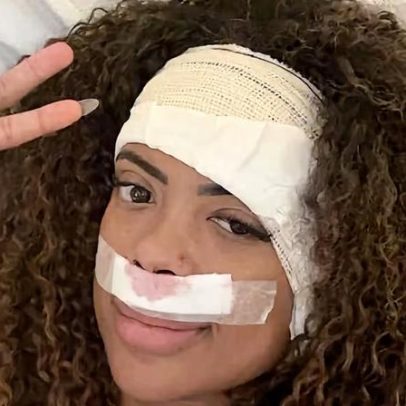 Marvvila tem estado de saúde atualizado após cirurgia de tumor no ouvido