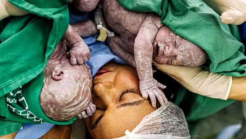 Bruna Lohaine mostra parto dos gêmeos — Foto: Instagram/Reprodução