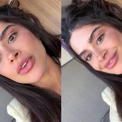 Aline Campos revela nova cirurgia realizada no mesmo dia do lifting facial