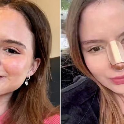 Sophia Valverde mostra resultado de plástica no nariz