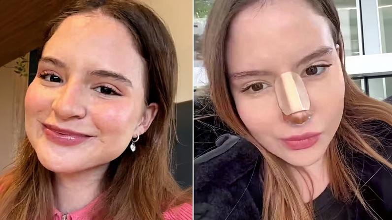 Sophia Valverde faz rinoseptoplastia