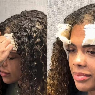 Marvvila procura médico por dor intensa após cirurgia de tumor no ouvido