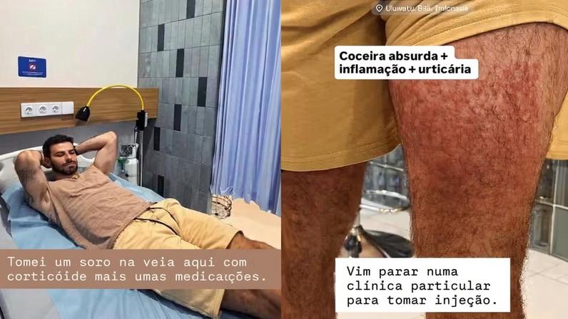 Lucas Malvacini sofre ataque de ácaros durante viagem à Indonésia — Foto: Reprodução | Instagram