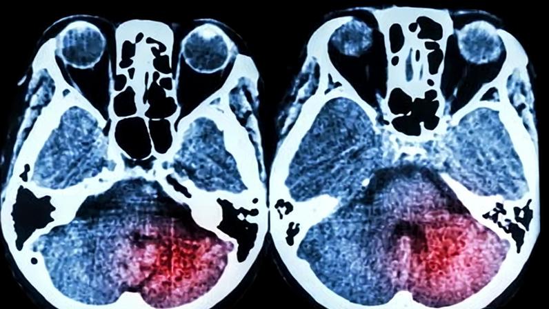 More than 100,000 people a year in the UK have a stroke, of whom 38,000 die and many others are left with life-changing disabilities.