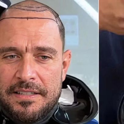 Diogo Nogueira raspa o cabelo; especialista explica transplante entre famosos
