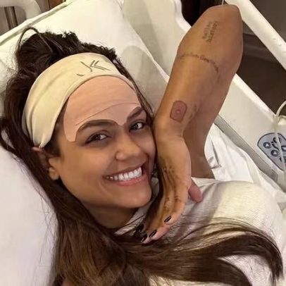 Camila Loures faz cirurgia para remover veia da testa