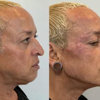 Walério Araújo, ex-A Fazenda, passa por transformação facial com estética