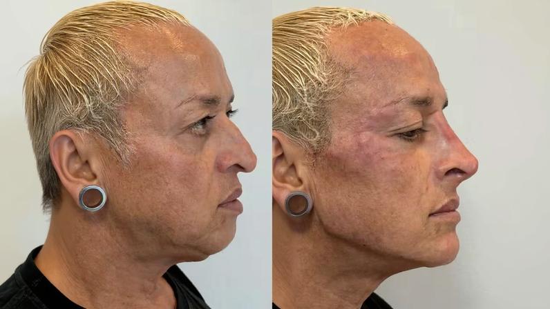 Walério Araújo, ex-A Fazenda, passa por transformação facial com estética