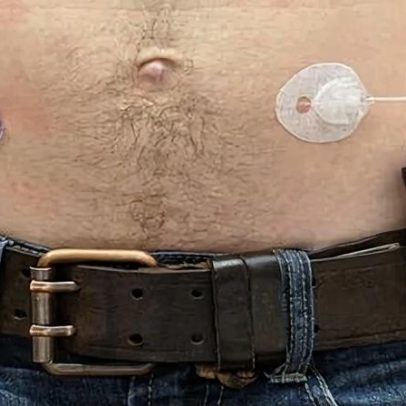 NHS implanta pâncreas artificial e reduz desigualdade no diabetes